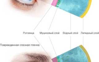 Что такое синдром сухого глаза и как лечить
