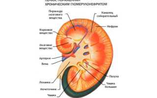 Симптомы и синдромы хронического гломерулонефрита