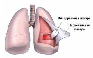 Синдром жидкости в грудной полости
