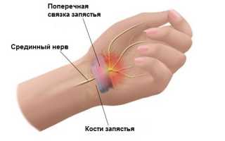 Туннельный синдром и упражнения для кистей рук