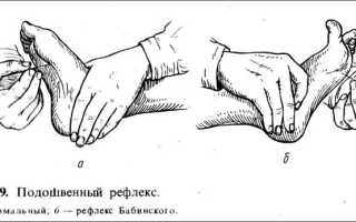 Синдром маринеску радовича что это