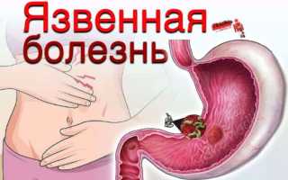 Кардиальный цирроз код по мкб 10