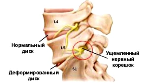 Остеохондроз корешковый синдром симптомы поясничного отдела