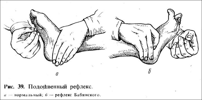 Подошвенный рефлекс