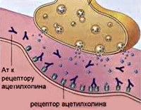 Миастения