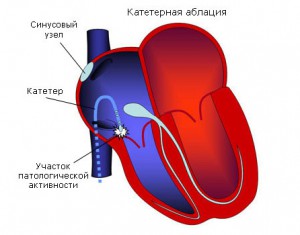 Синдром укороченного интервала что это такое