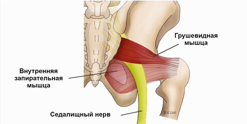 Лечение синдрома грушевидной мышцы народными средствами