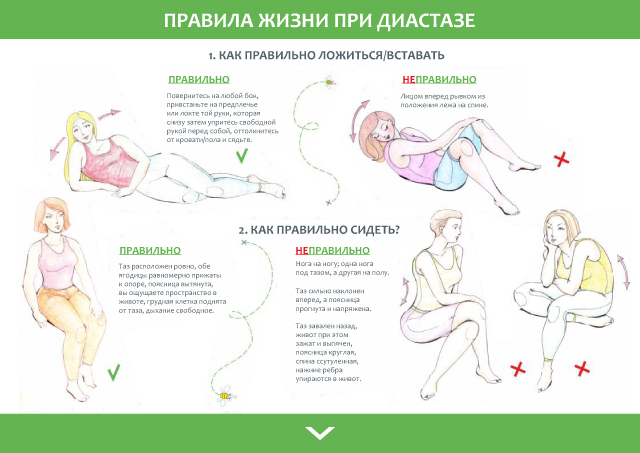 Птоз брюшной стенки код мкб