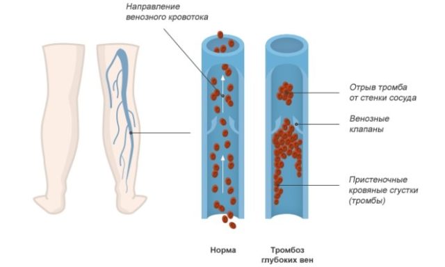 Основными факторами, которые способны спровоцировать тромбофлебит глубоких вен, являются:инфекционные возбудители