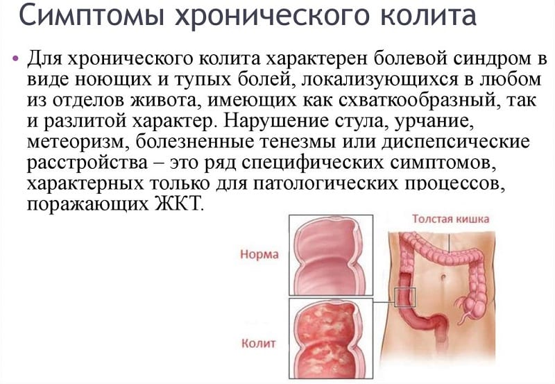 Признаки спастического колита и как его лечить
