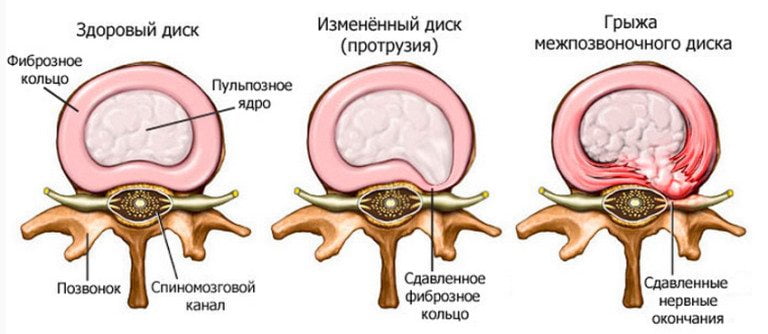 Корешковый синдром после удаления грыжи диска