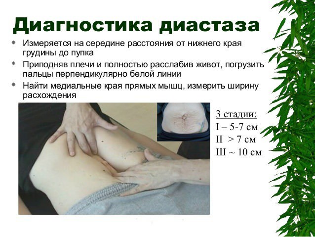 Птоз брюшной стенки код мкб