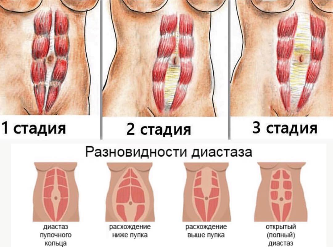 Птоз брюшной стенки код мкб