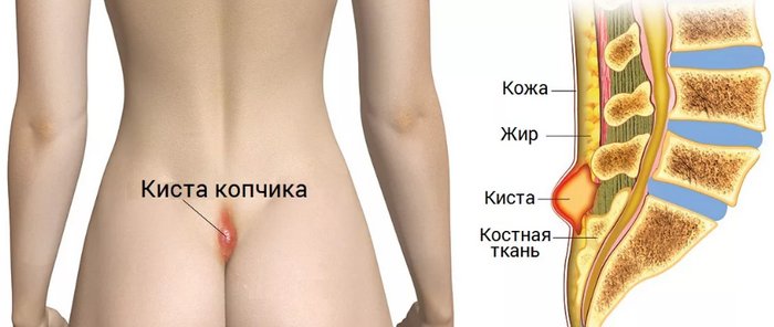 эпителиальный копчиковый ход
