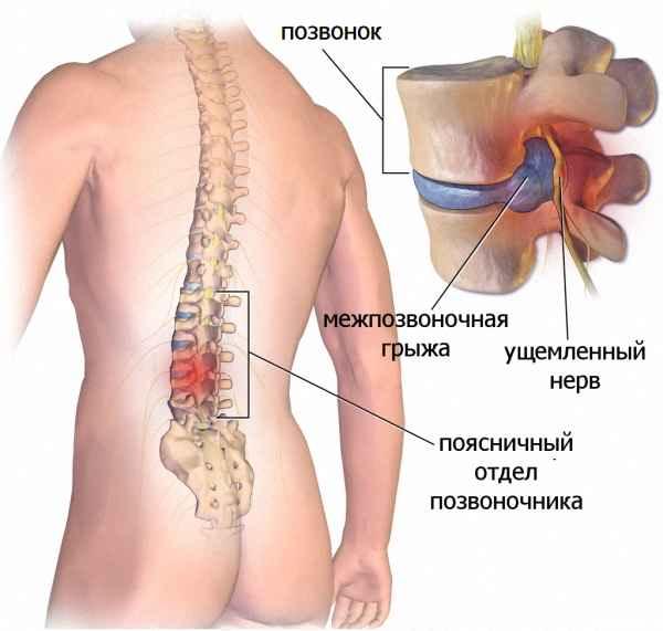 Корешковый синдром после удаления грыжи диска