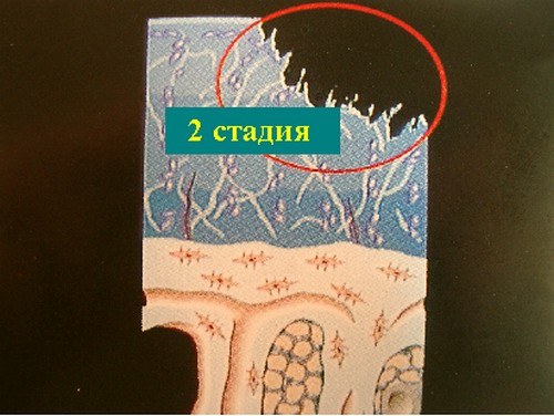 Хондромаляция надколенника. 2 стадия.