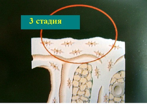 Хондромаляция надколенника. 3 стадия.