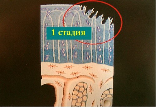 Хондромаляция надколенника. 1 стадия.