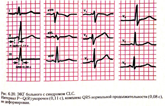 Экг синдром clc что это