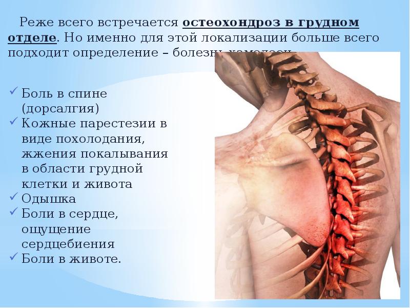 Остеохондроз корешковый синдром симптомы поясничного отдела