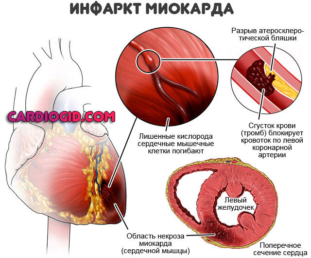 инфаркт-миокарда