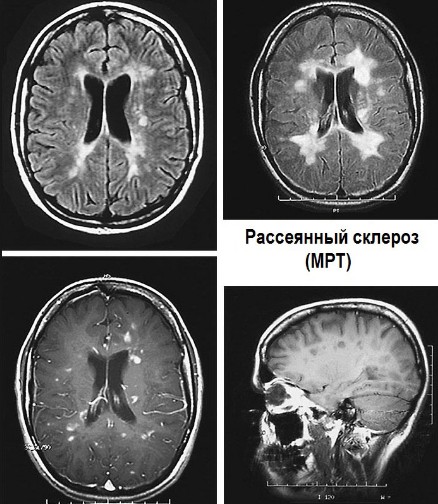 Видно ли рассеянный склероз на МРТ