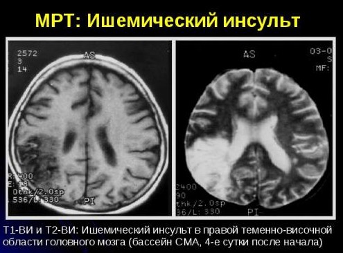 МРТ при инсульте