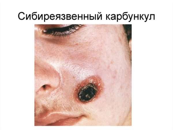 Код по мкб фурункула