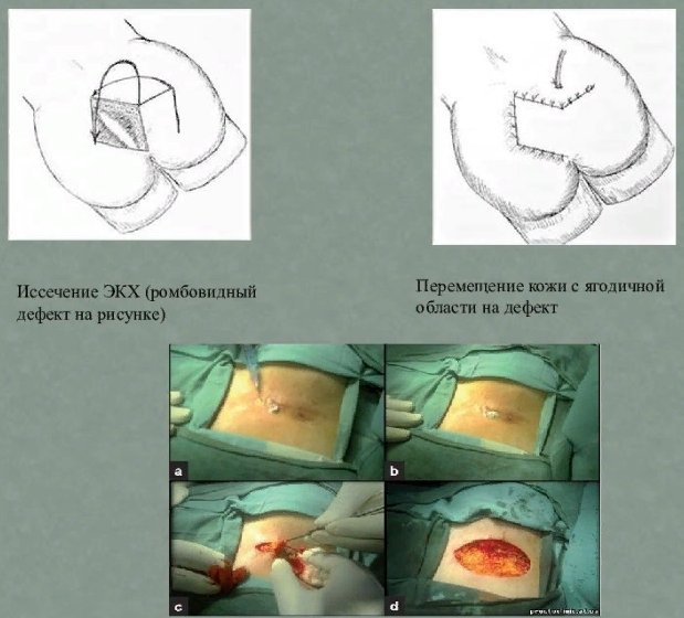 операция при кисте кобчика - ЭКХ