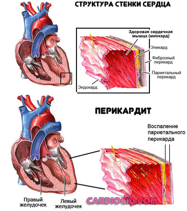 перикардит