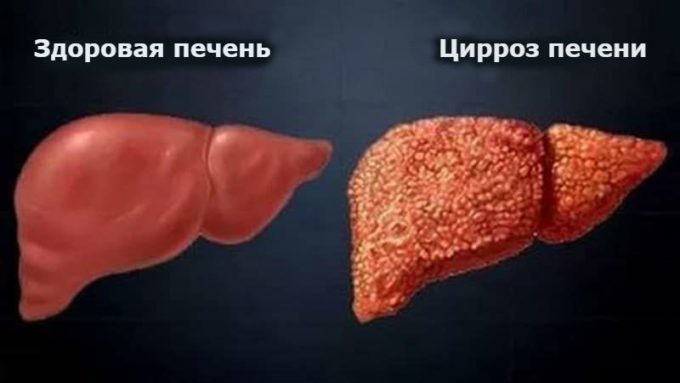 Синдром повышение билирубина в крови у