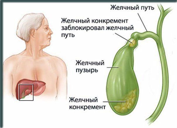 Синдром повышение билирубина в крови у