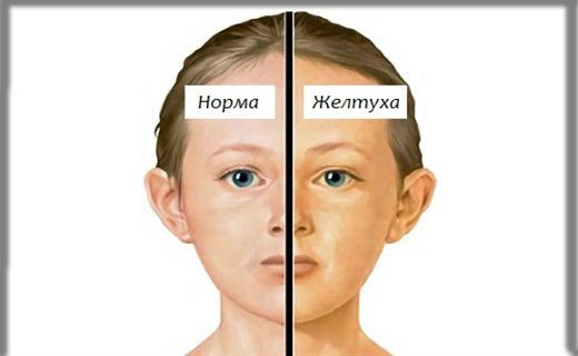 Синдром повышение билирубина в крови у