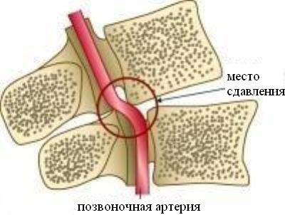 позвоночная артерия