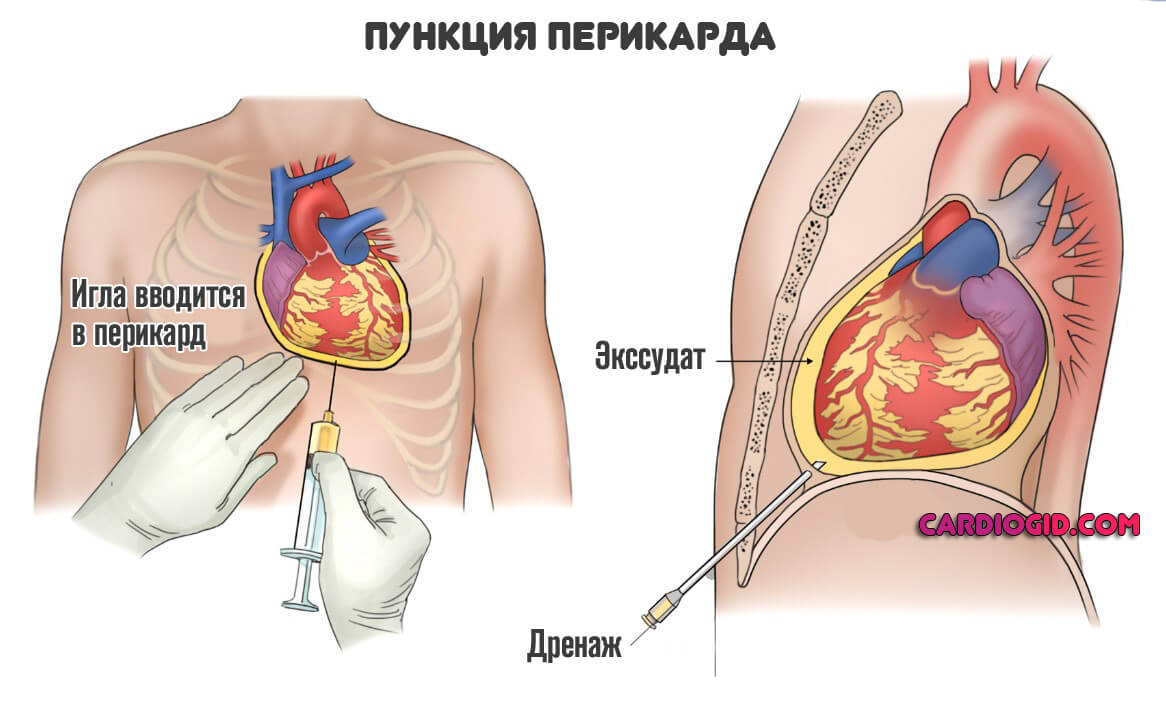 прокол-при-тампонаде