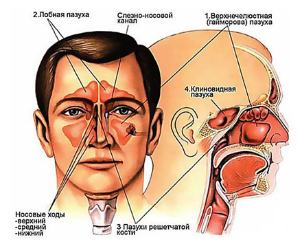 Риносинусит