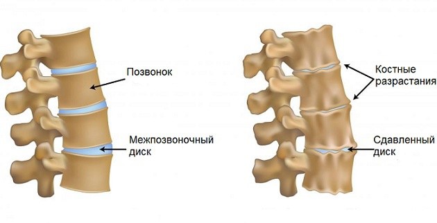 позвоночник при артрозе