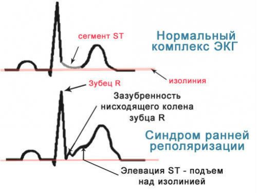 СРРЖ на ЭКГ