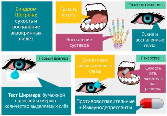 симптомы синдрома шегрена