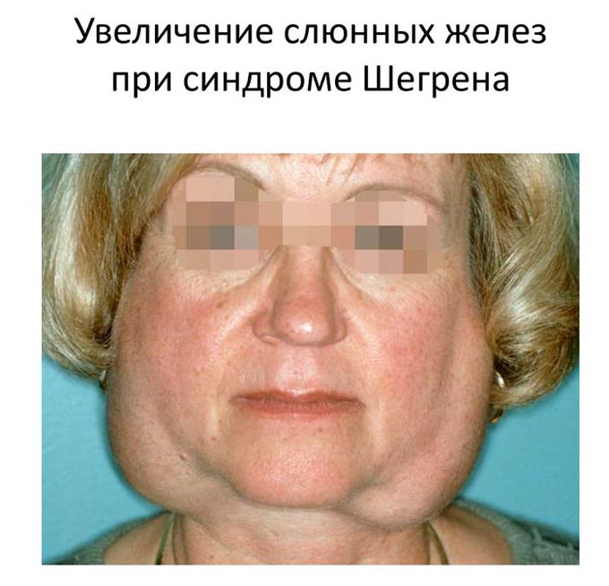 увеличение слюнных желез при синдроме шегрена