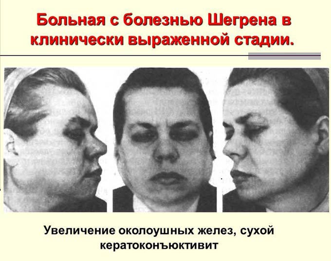 сухой кератоконъюнктивит