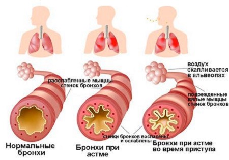 Бронхоспазм