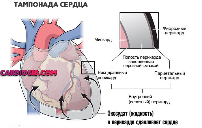 тампонада-сердца