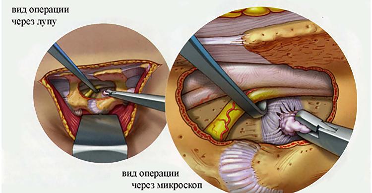 Корешковый синдром после удаления грыжи диска