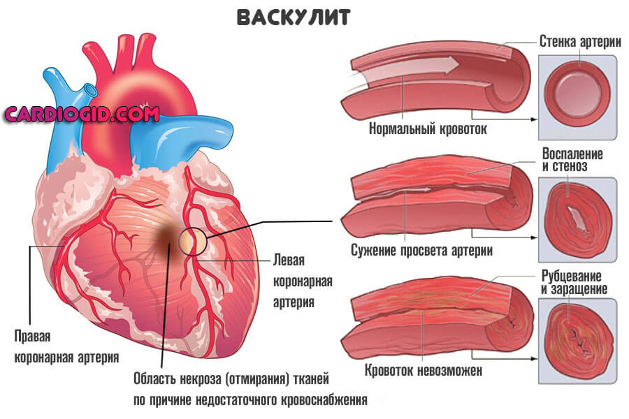 васкулит