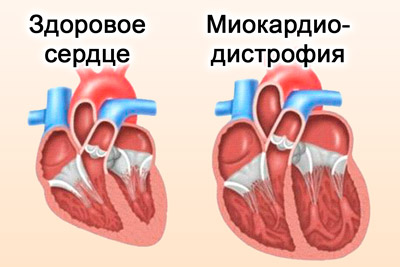 Сердце с миокардиодистрофией